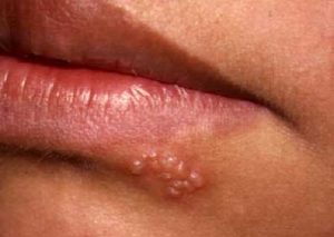 herpes labial