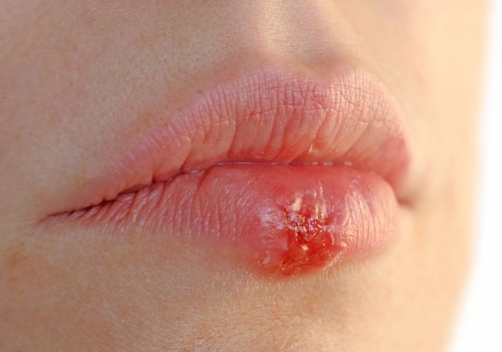 herpes labial