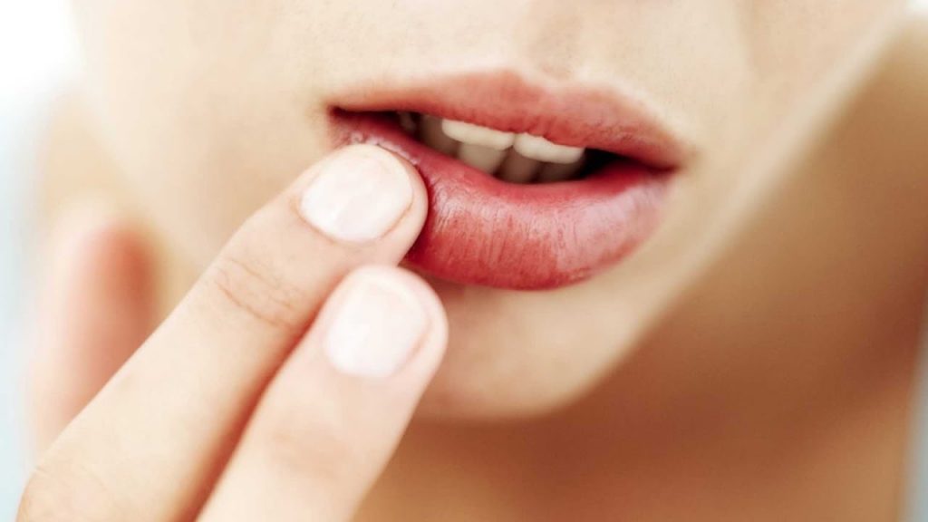 herpes en el labio, que alimentos no comer