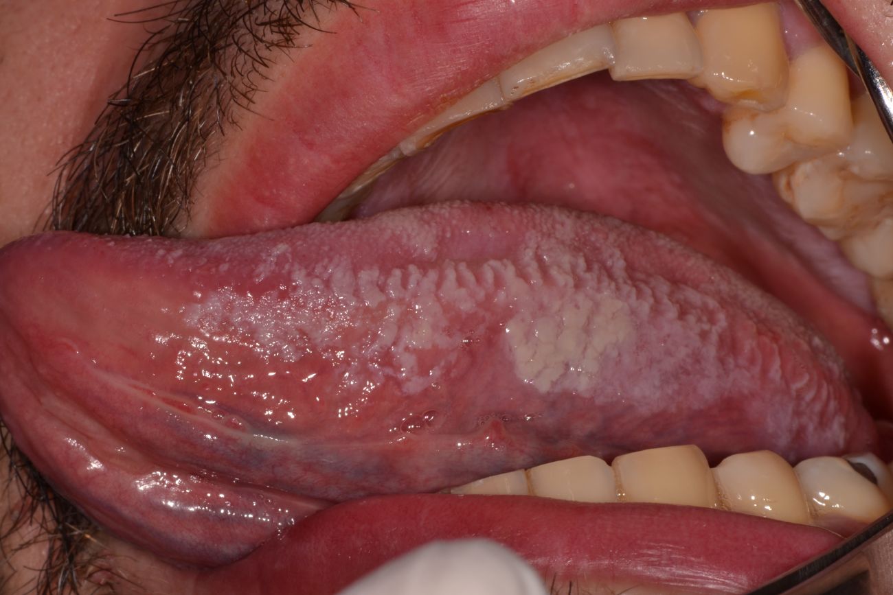 sintomas del herpes en la lengua