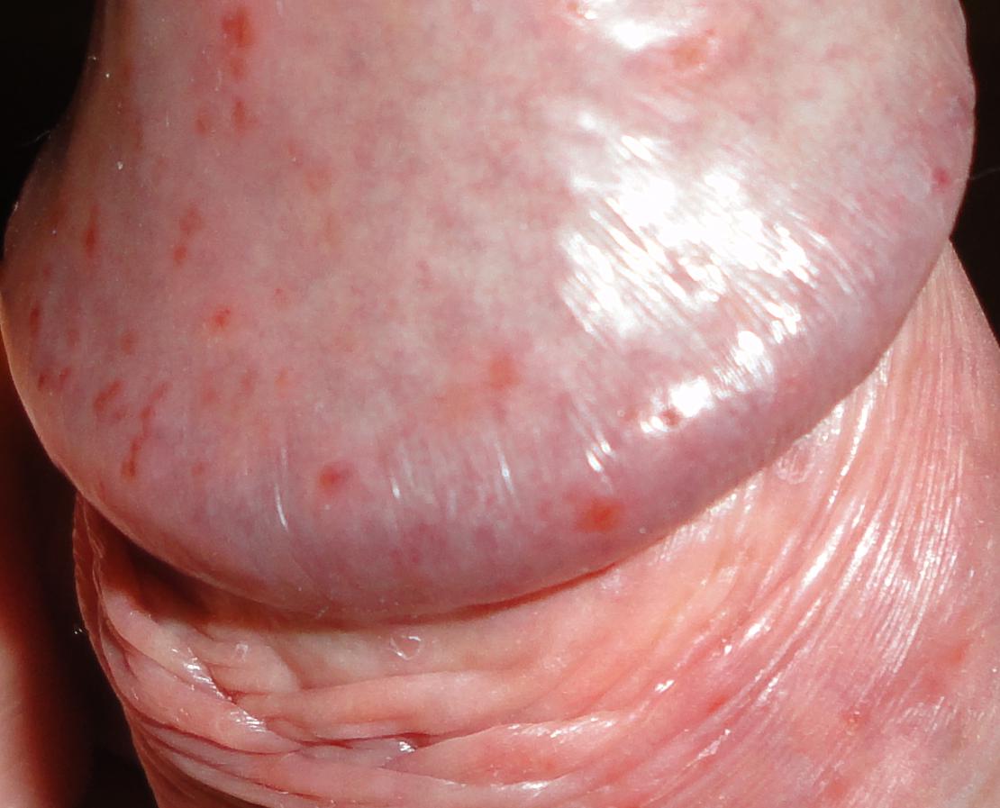 Sintomas del herpes genital masculino en el pene