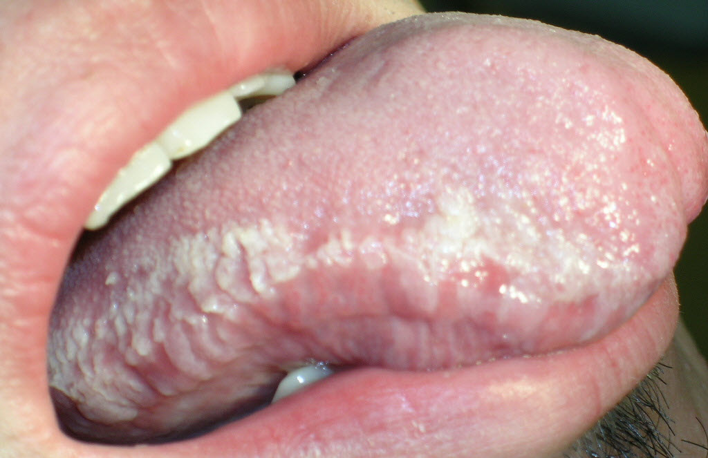 Herpes en lengua o herpes bucal