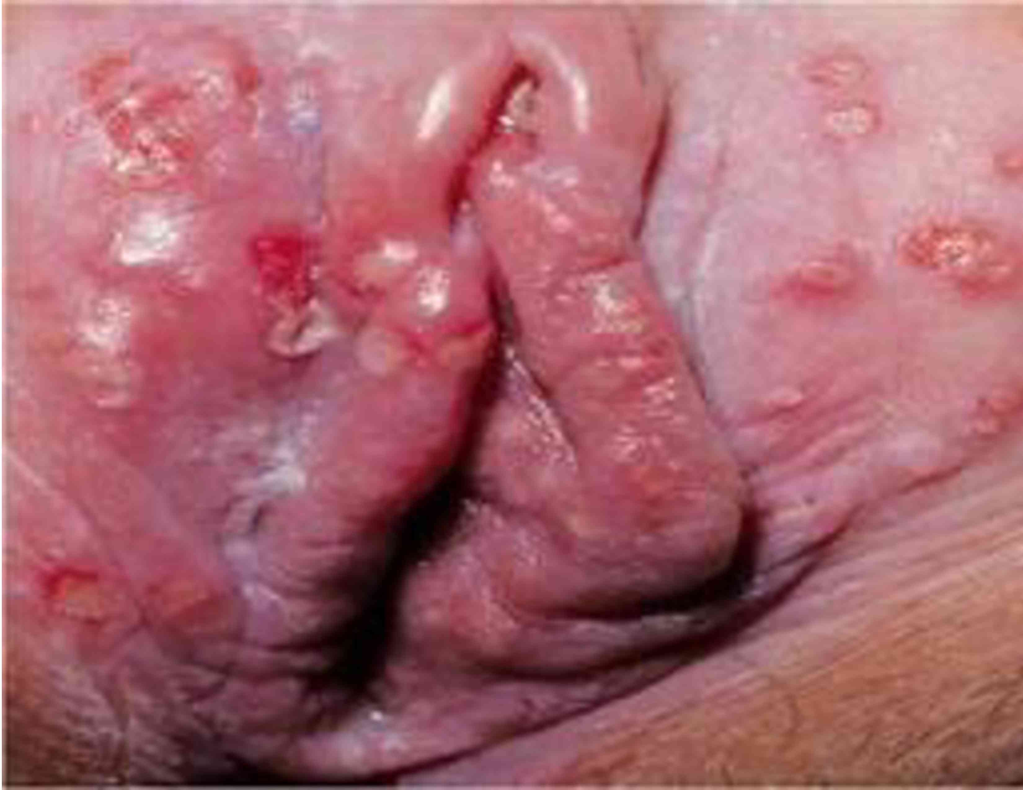 El herpes genital femenino se reproduce en la vagina